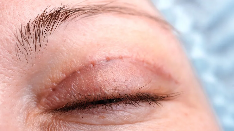 cicatriz blefaroplastia superior