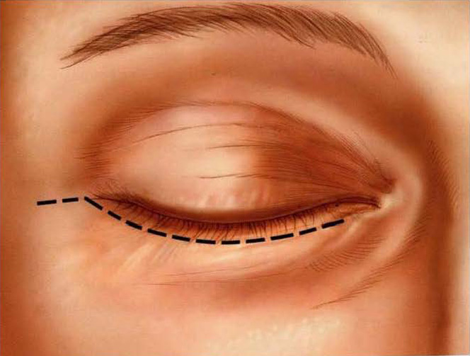 Blefaroplastia inferior
