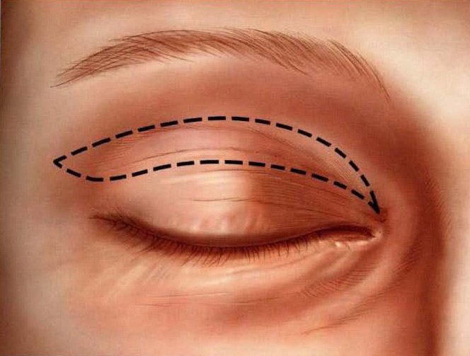 Blefaroplastia superior