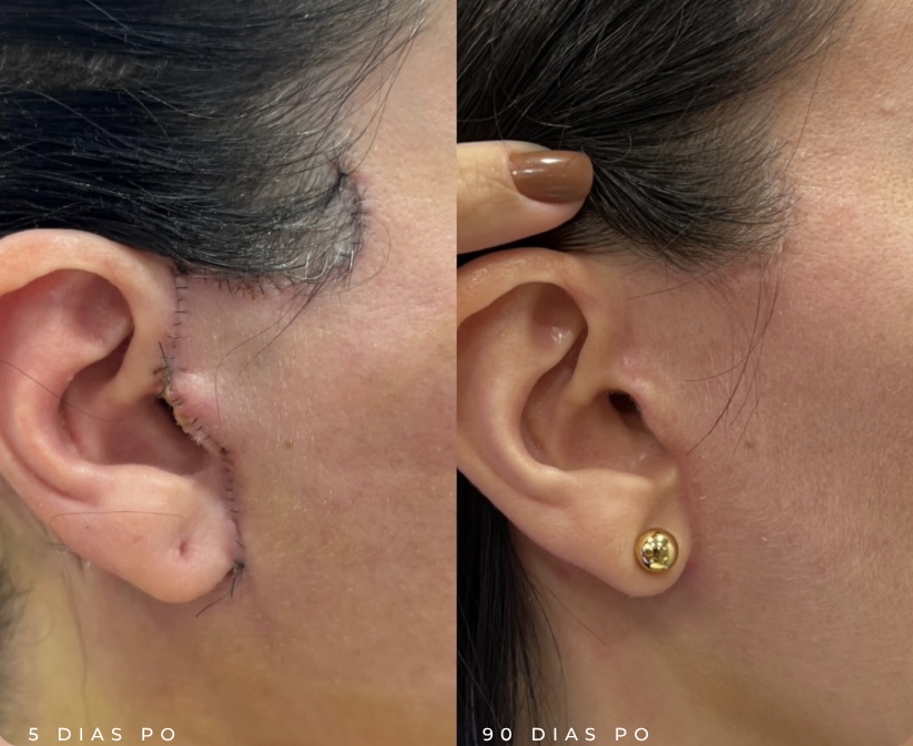 lifting de face
facelift
dra rafaela marques
ribeirão preto