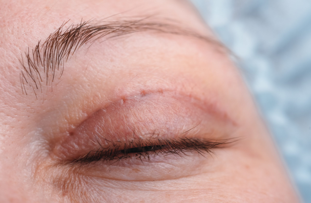 blefaroplastia