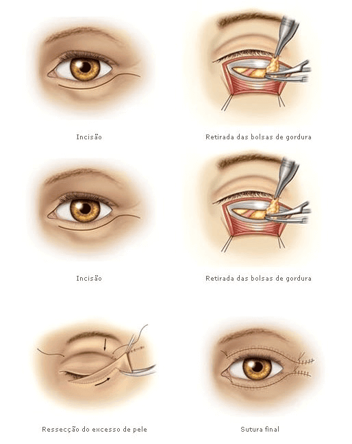 blefaroplastia
dra Rafaela Marques
ribeirão preto