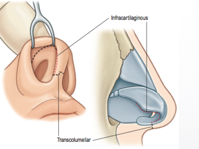 Rinoplastia aberta