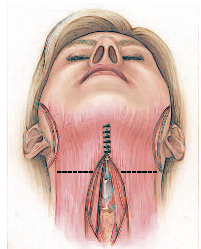 cervicoplastia