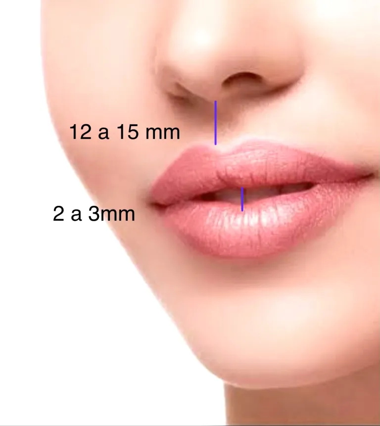 Lip lift