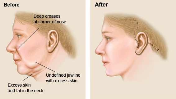 lifting facial