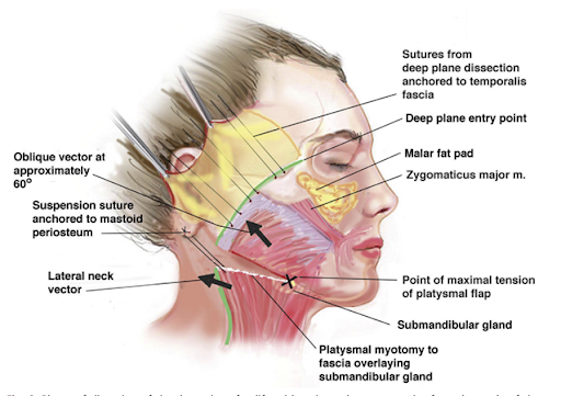 lifting facial