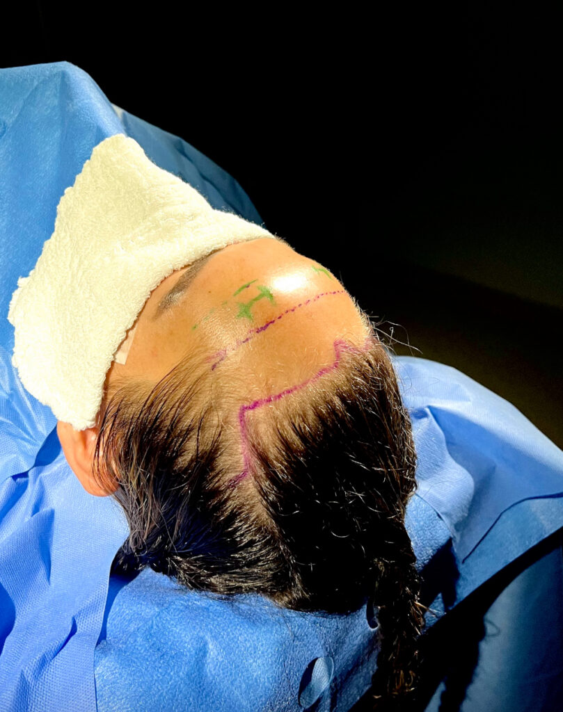 frontoplastia cranioplastia