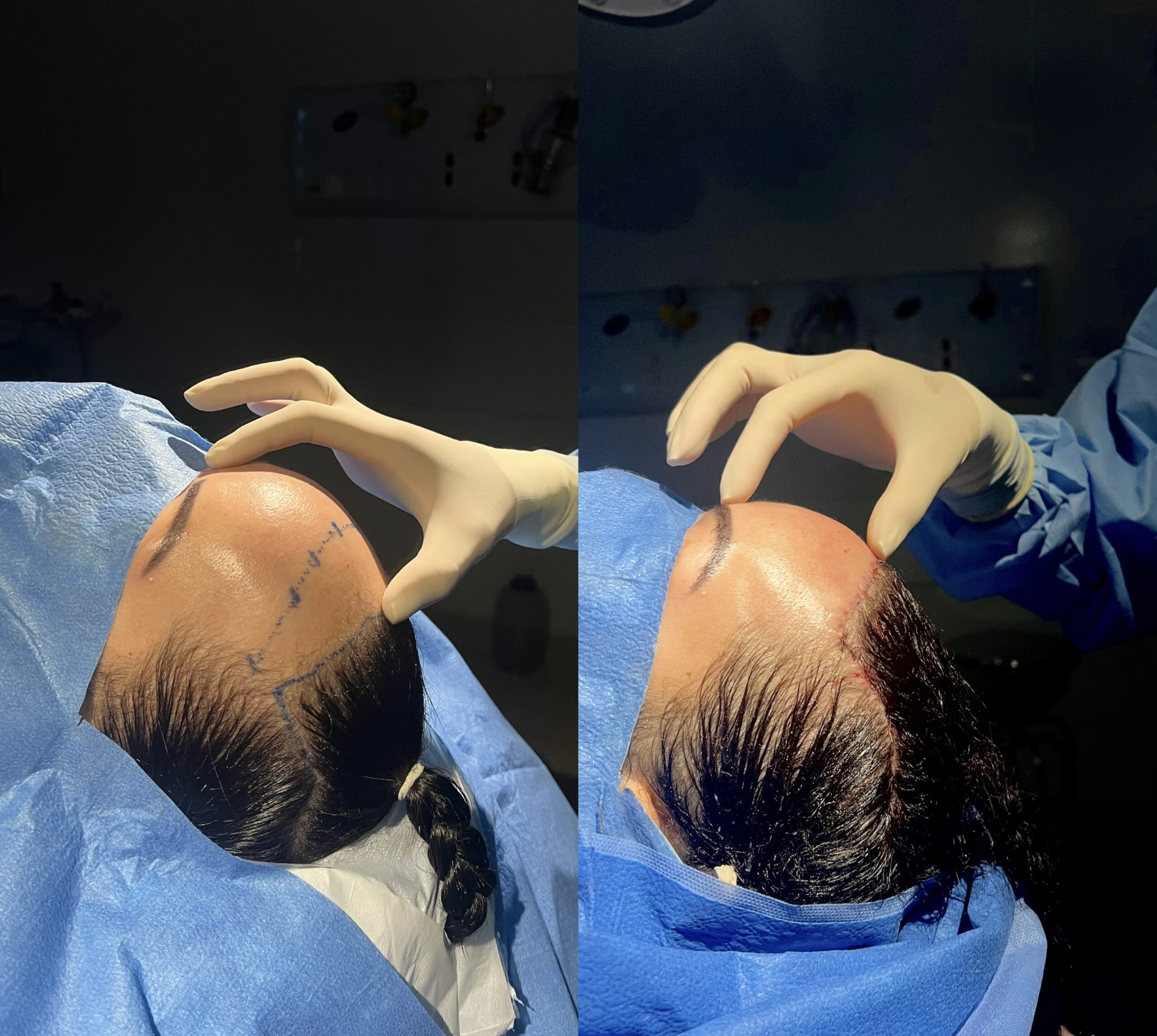 frontoplastia
cranioplastia
