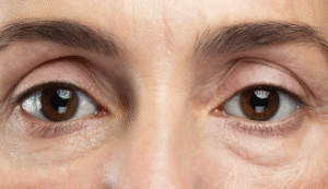 blefaroplastia