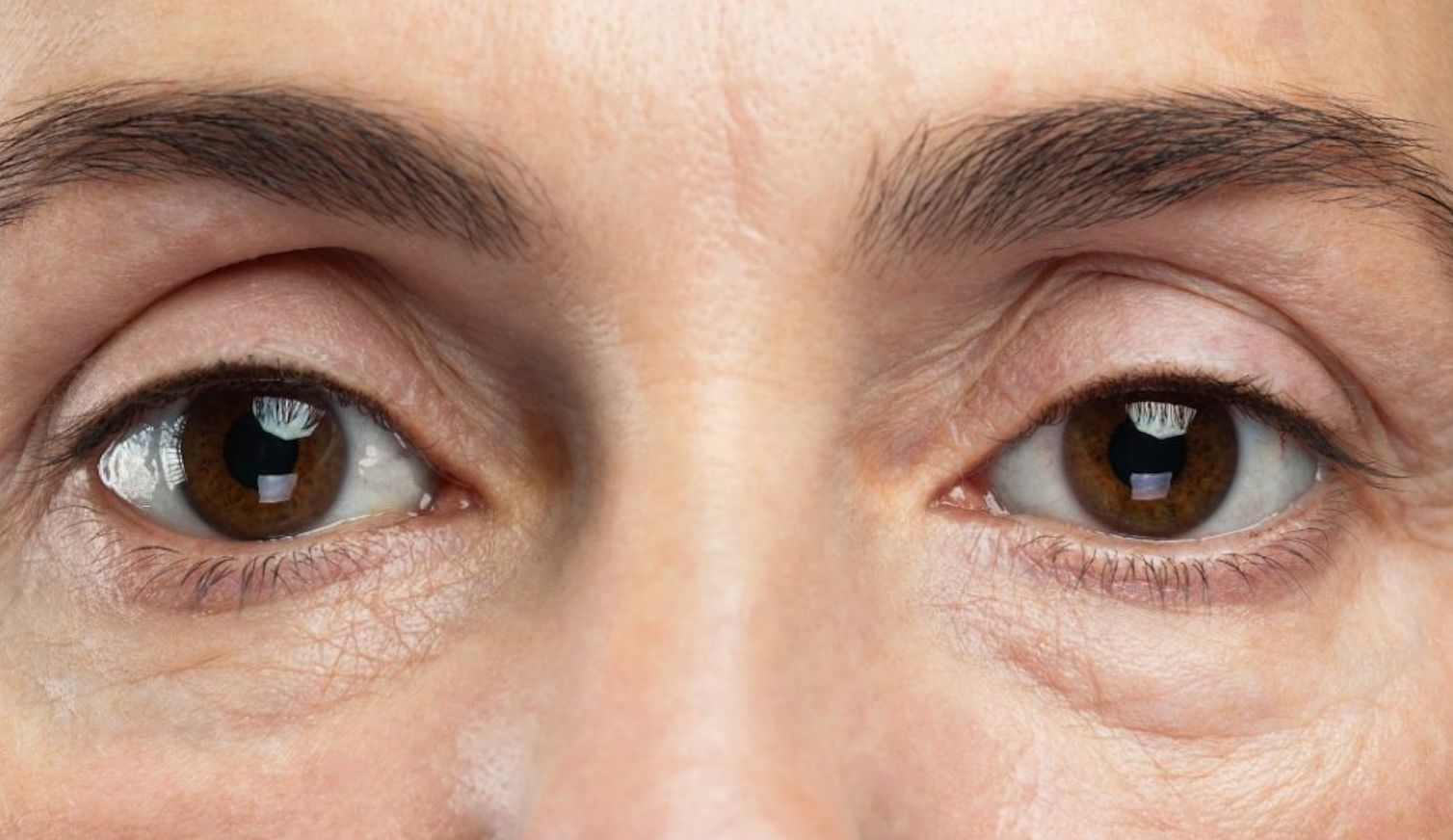blefaroplastia