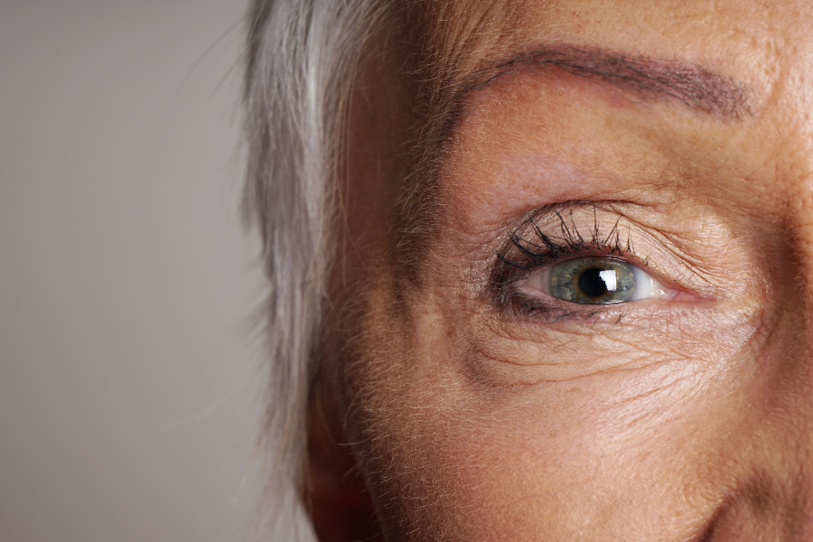 blefaroplastia