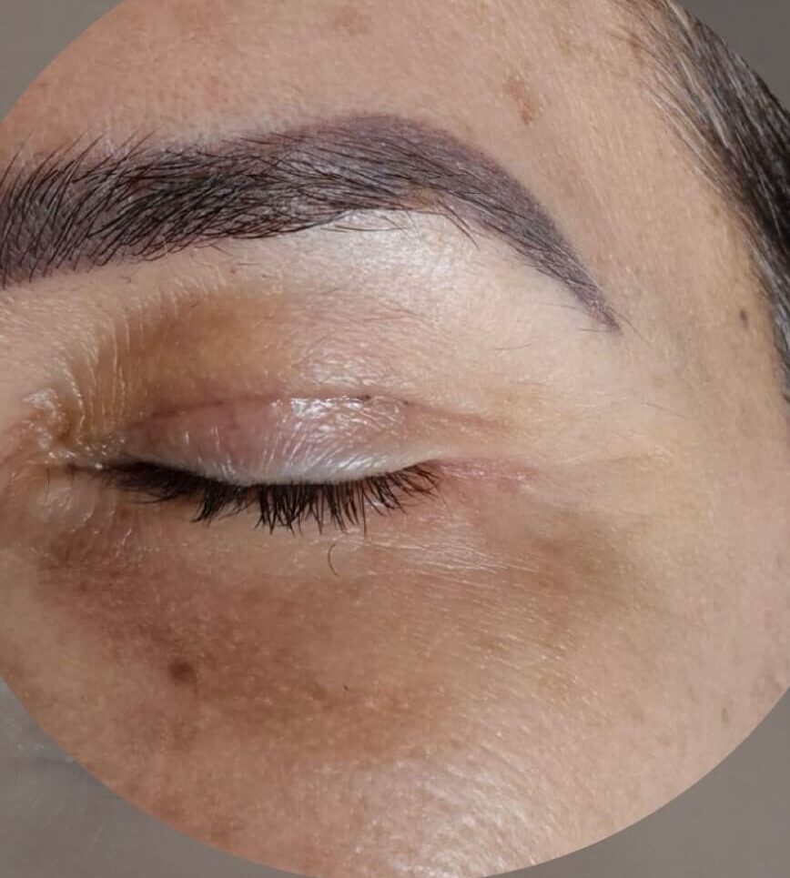 blefaroplastia
dra Rafaela Marques
ribeirão preto