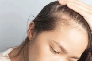 dra rafaela marques frontoplastia avanço da linha capilar