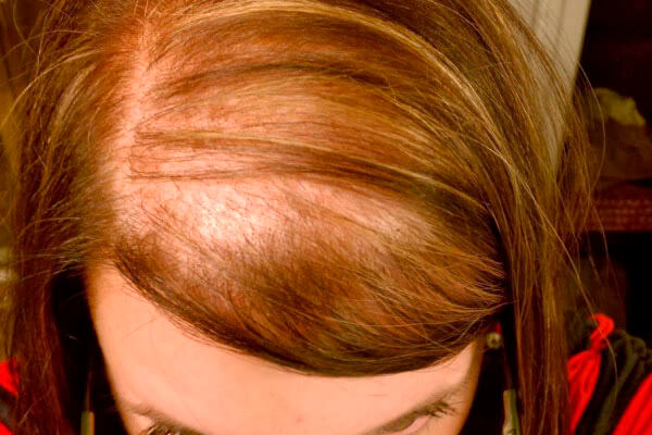 dra rafaela marques
frontoplastia 
queda de cabelo