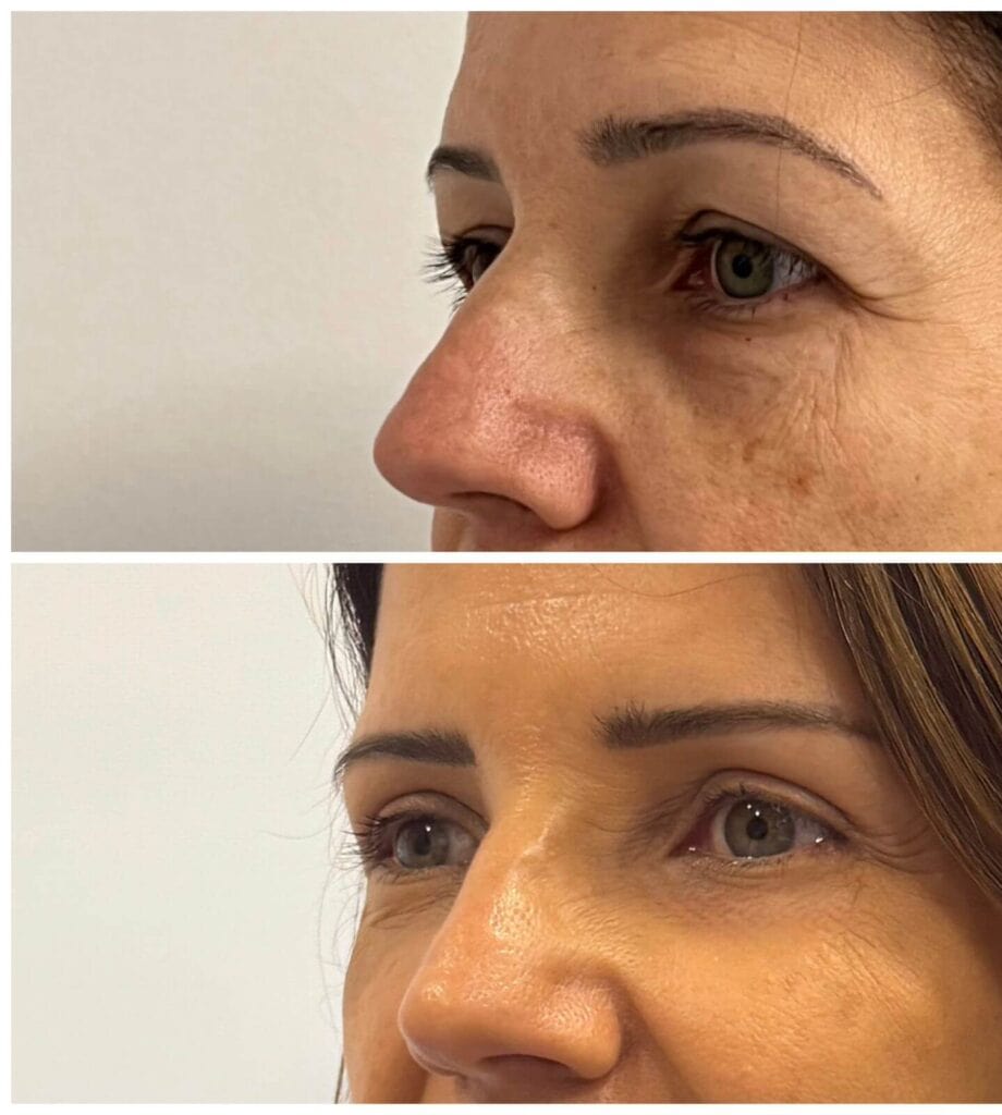 blefaroplastia
Ribeirão Preto
dra rafaela marques
