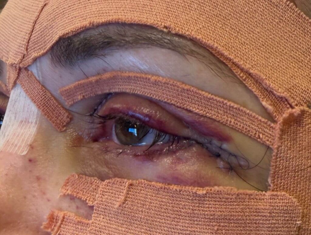 blefaroplastia
Ribeirão Preto
dra rafaela marques