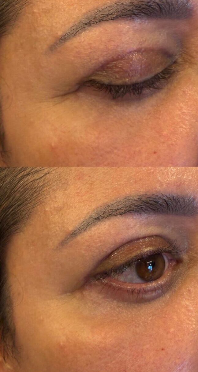 blefaroplastia
Ribeirão Preto
dra rafaela marques
