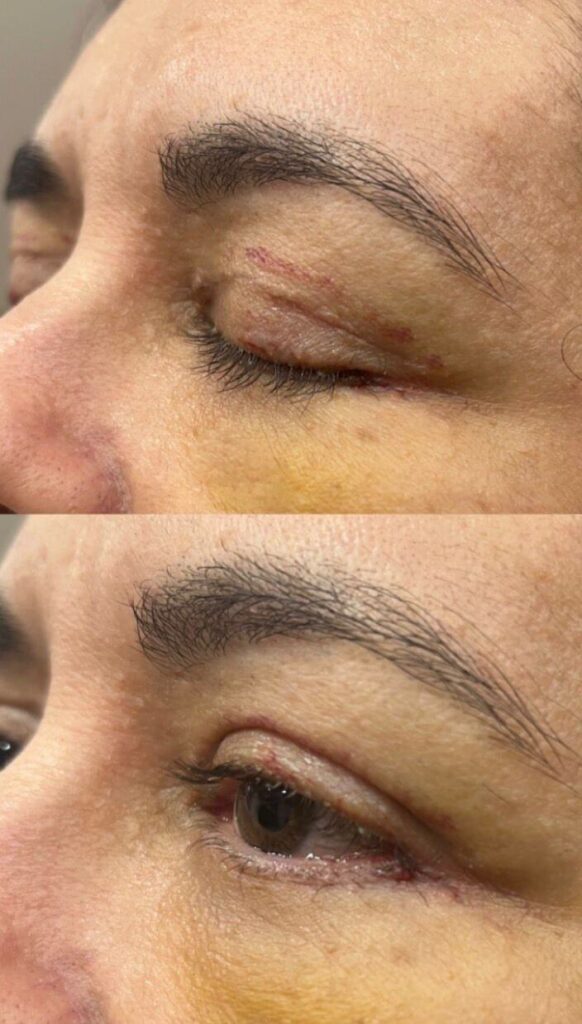 blefaroplastia
Ribeirão Preto
dra rafaela marques