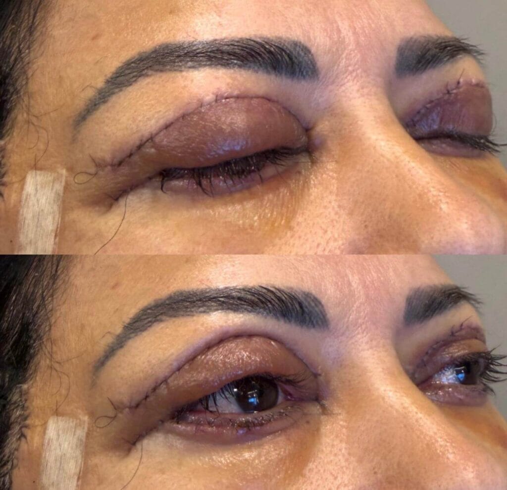 blefaroplastia
Ribeirão Preto
dra rafaela marques