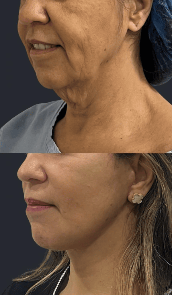 dra rafaela marques
deep plane facelift
ribeirão preto