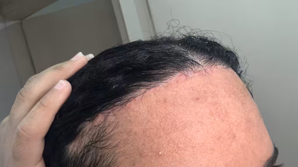 dra rafaela marques
frontoplastia
Ribeirão Preto